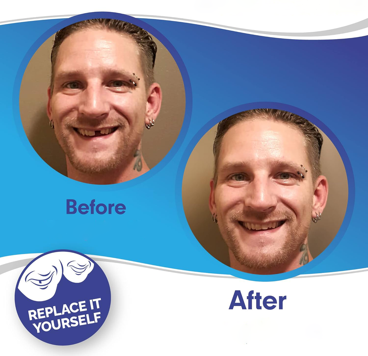 Cosmetic dental veneers before-and-after smiles on two people