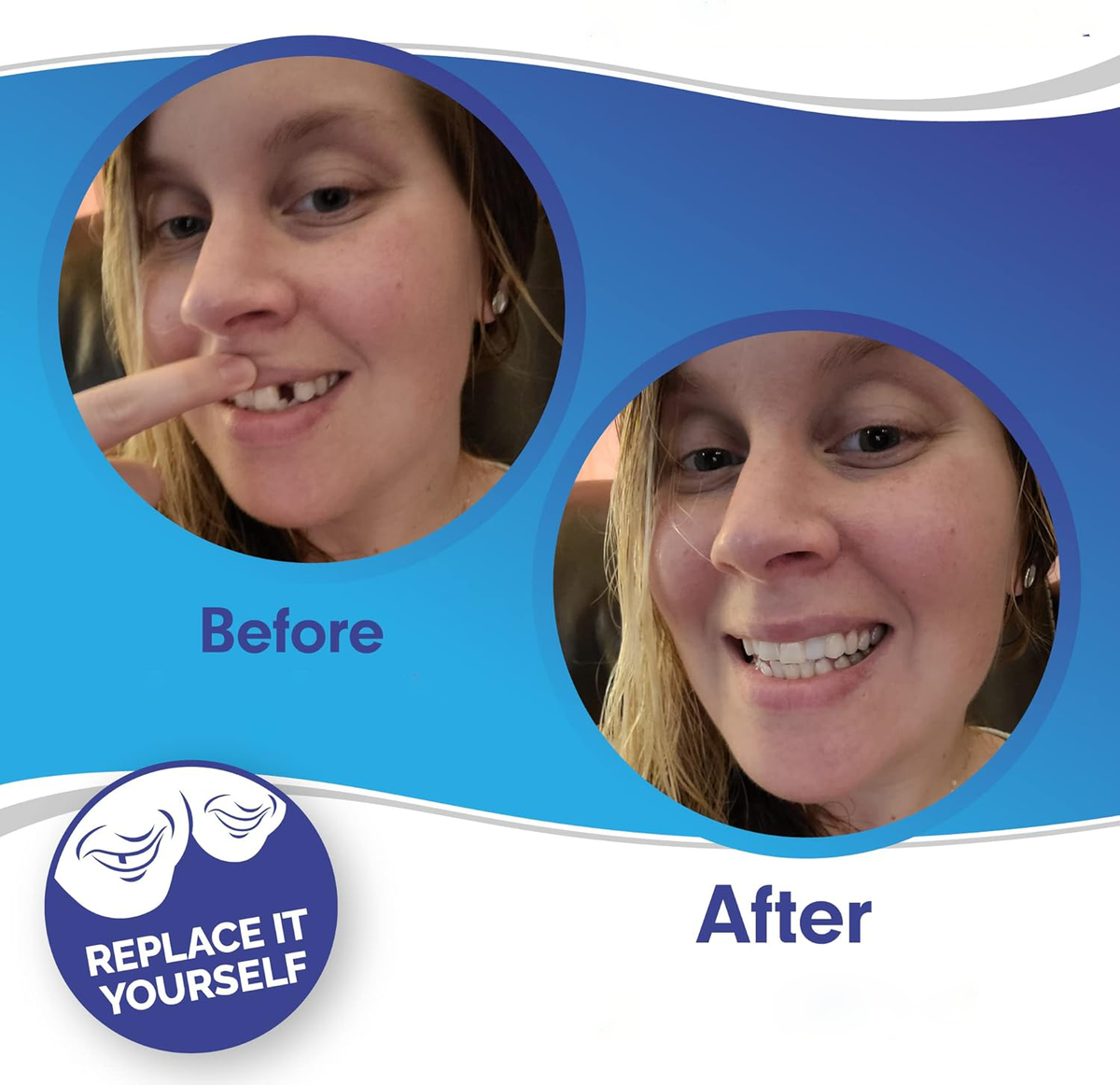 Cosmetic dental veneers before-and-after smile on a smiling woman