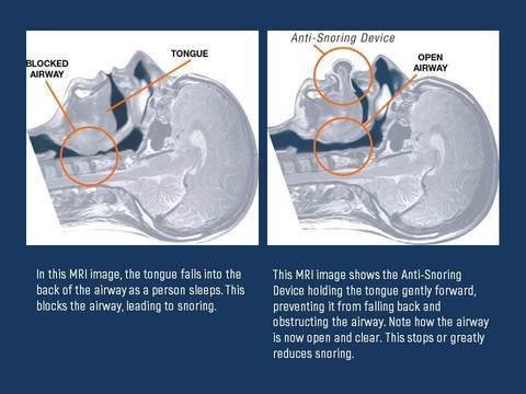 Side-view illustration of tongue-stabilizing device on airway with blocking and opening arrows